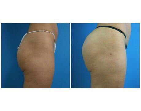 Achieve Natural Results With a Brazilian Butt Lift - Los Angeles, CA