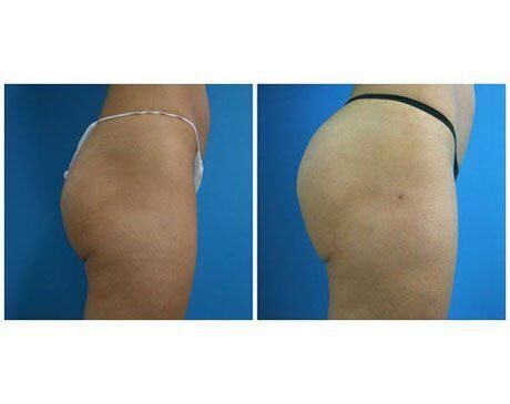 Achieve Natural Results With a Brazilian Butt Lift - Los Angeles