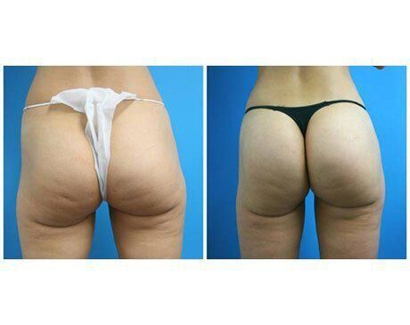 Athletic Brazilian Butt Lift (BBL) Miami, FL - Dr. Zachary Okhah