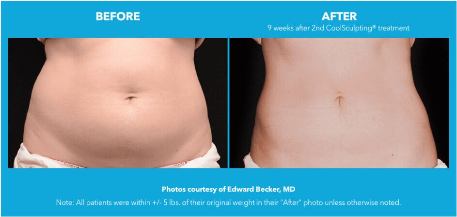 Long-term Effects of Coolsculpting, Beverly Hills, Los Angeles