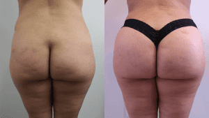 Brazilian Butt Lift Before & After - See Top MD BBL Results