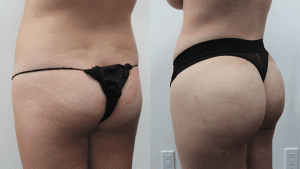Brazilian Butt Lift Before and After Pictures Case 23456, Orlando, FL