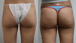 Patient 8522196, Brazilian Butt Lift (BBL) Before & After Photos