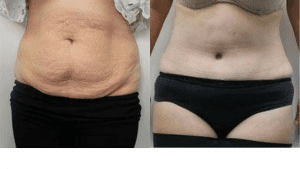 Tummy Tuck Before and Afters