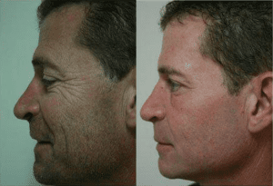 CO2 LASER TREATMENT BEFORE & AFTER PHOTOS